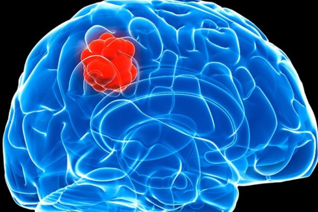What is an Oligodendroglioma -  Risks, Causes, Diagnosis and Treatment