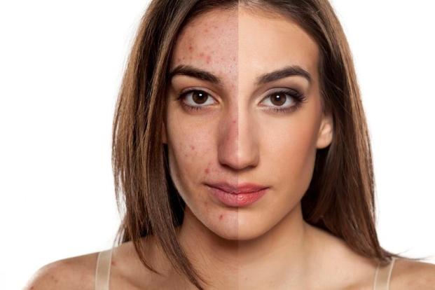 TIPS TO TREATING ACNE SCARS AND SKIN DAMAGE