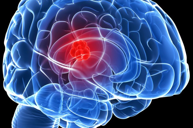 Types of brain tumor