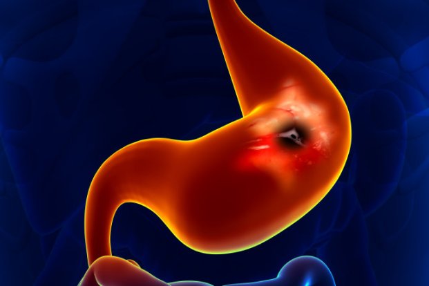 Symptoms of Stomach or Gastric Cancer