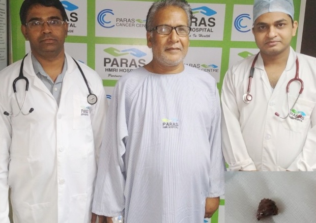 Paras HMRI Hospital relieves a patient by helping him get rid of a betel nut stuck in lungs which was removed by bronchoscopy