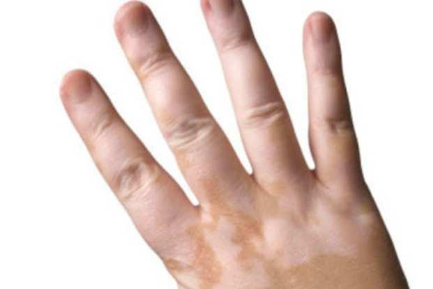 Vitiligo - Symptoms and Causes