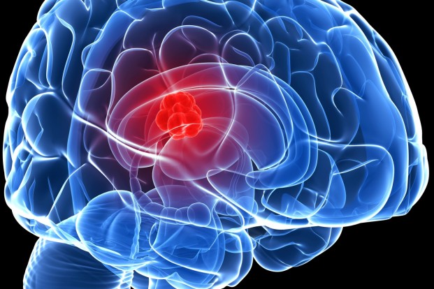 Brain Tumor: How Can You Detect It And What Are The Best Preventive Measures To Follow?
