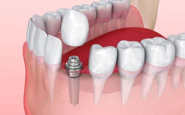 Know all about Dental Implants