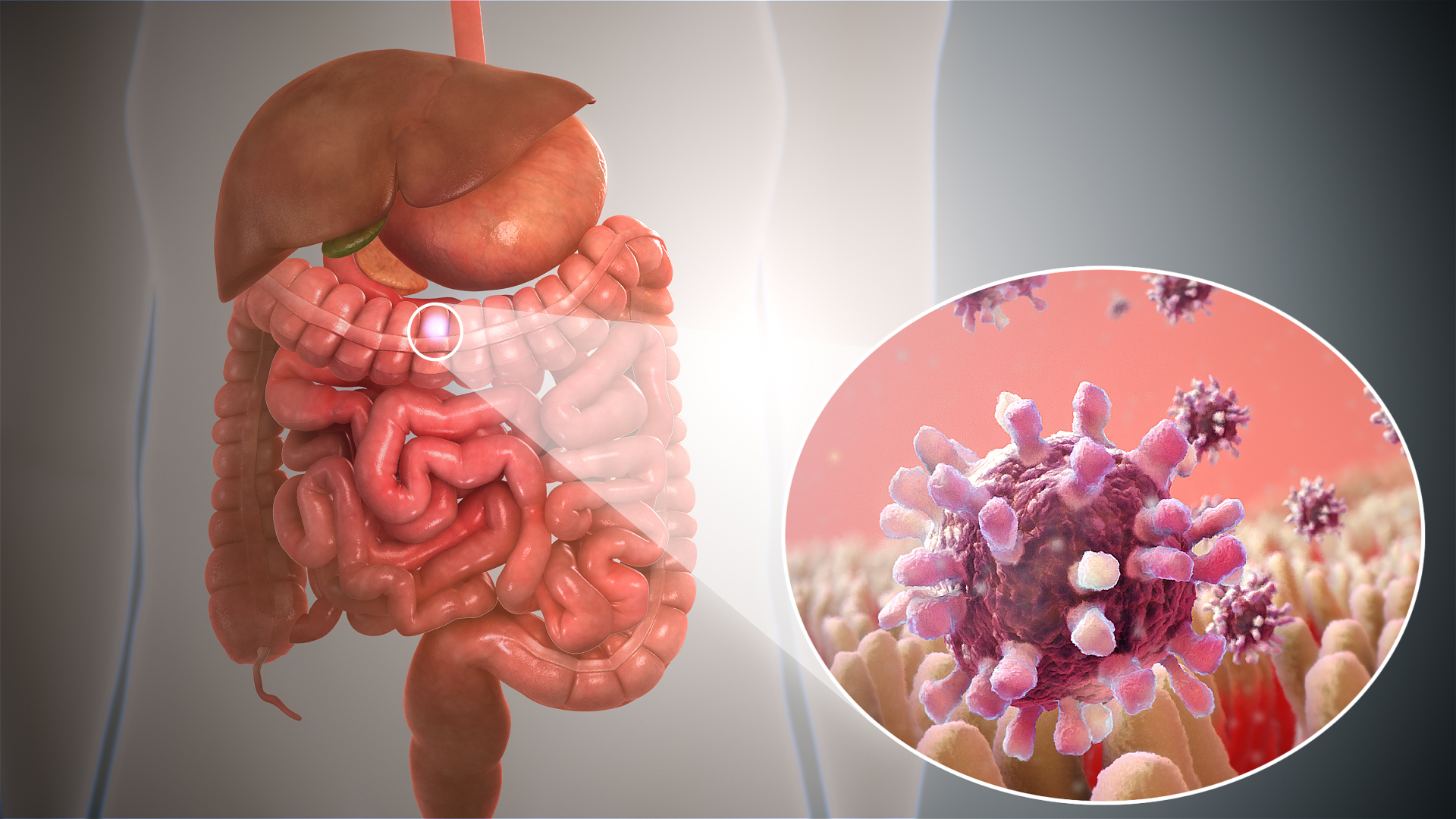 Signos Y Sintomas De La Gastroenteritis En Niños