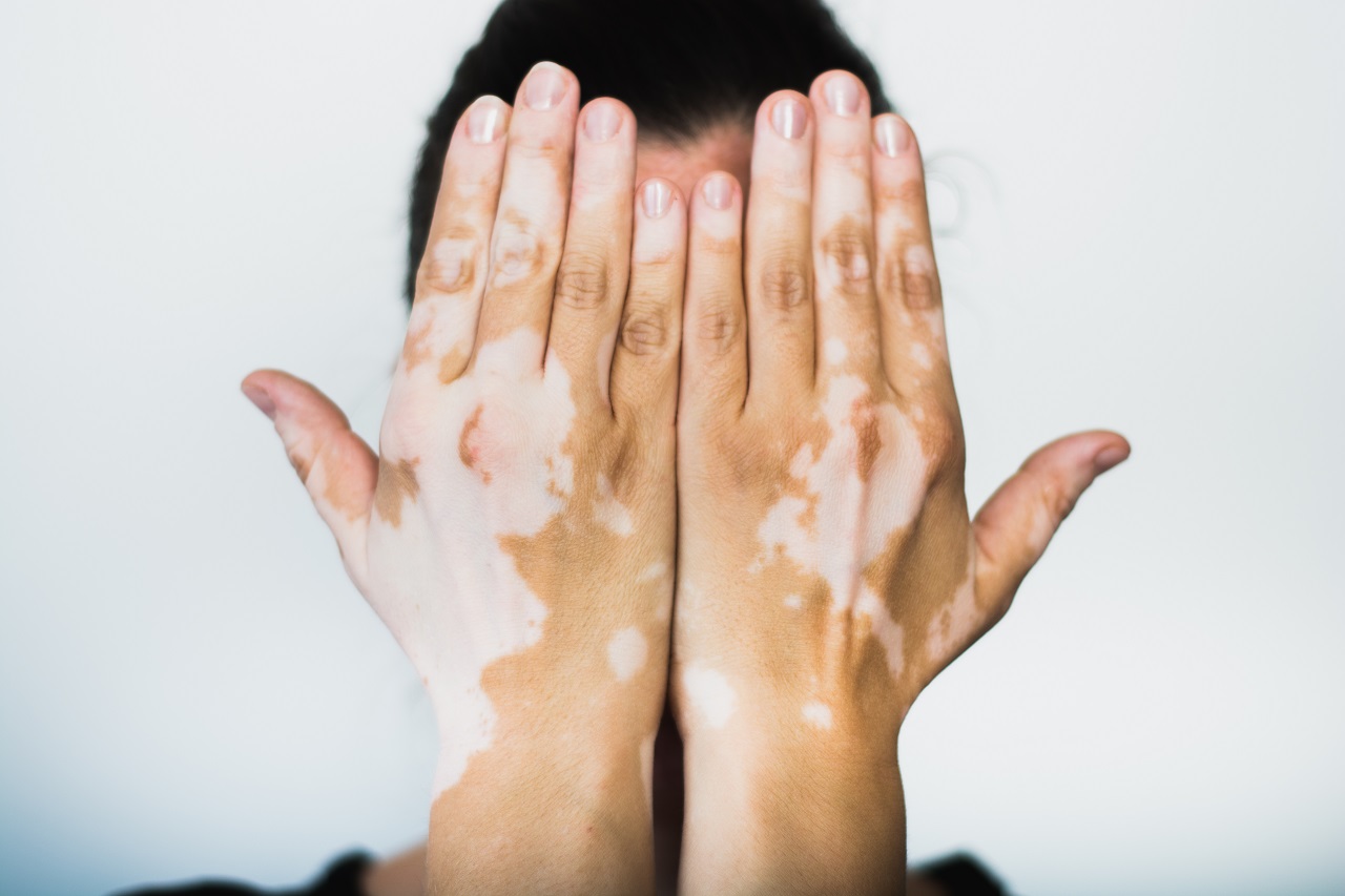 Know all about Vitiligo