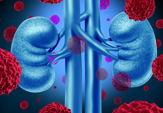 Management of Metastatic Renal Cell Carcinoma
