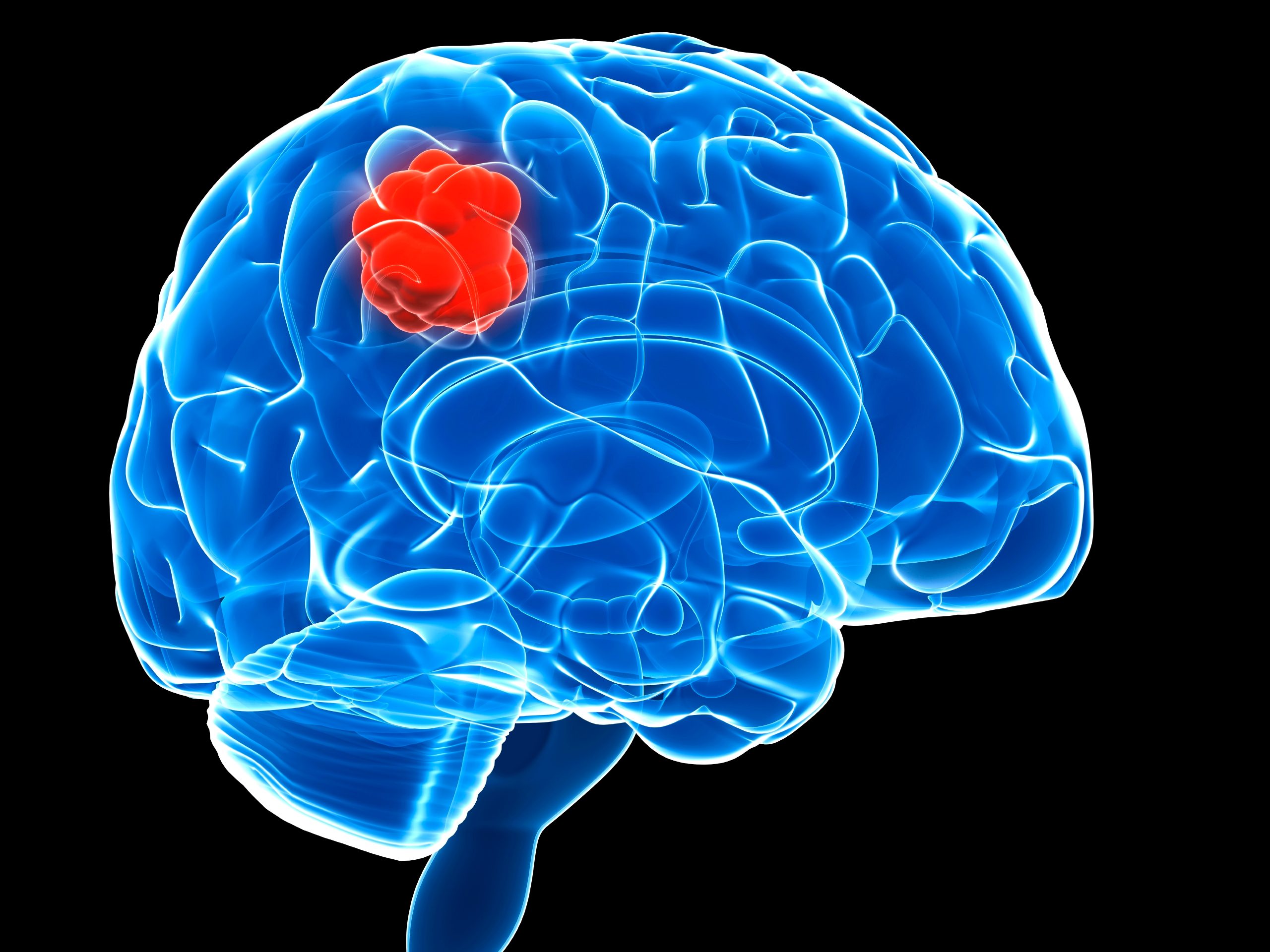How Does Brain Tumour Affects The Brain?
