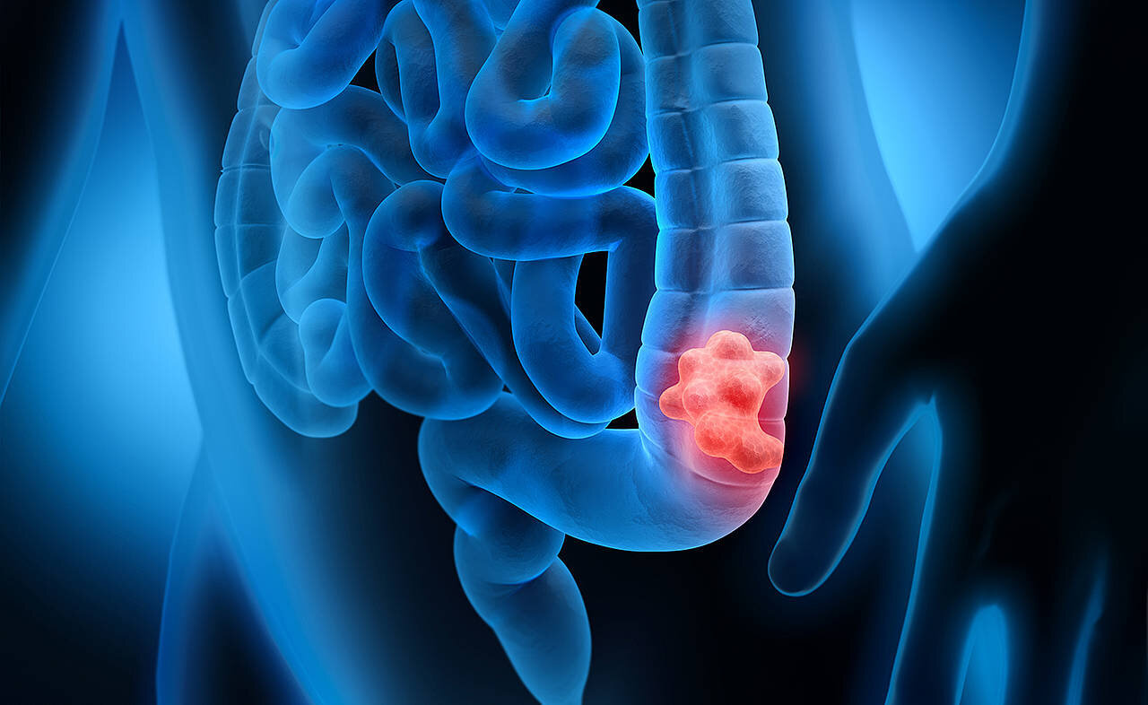 Is laparoscopic (keyhole) surgery the best option for colorectal cancer treatment?