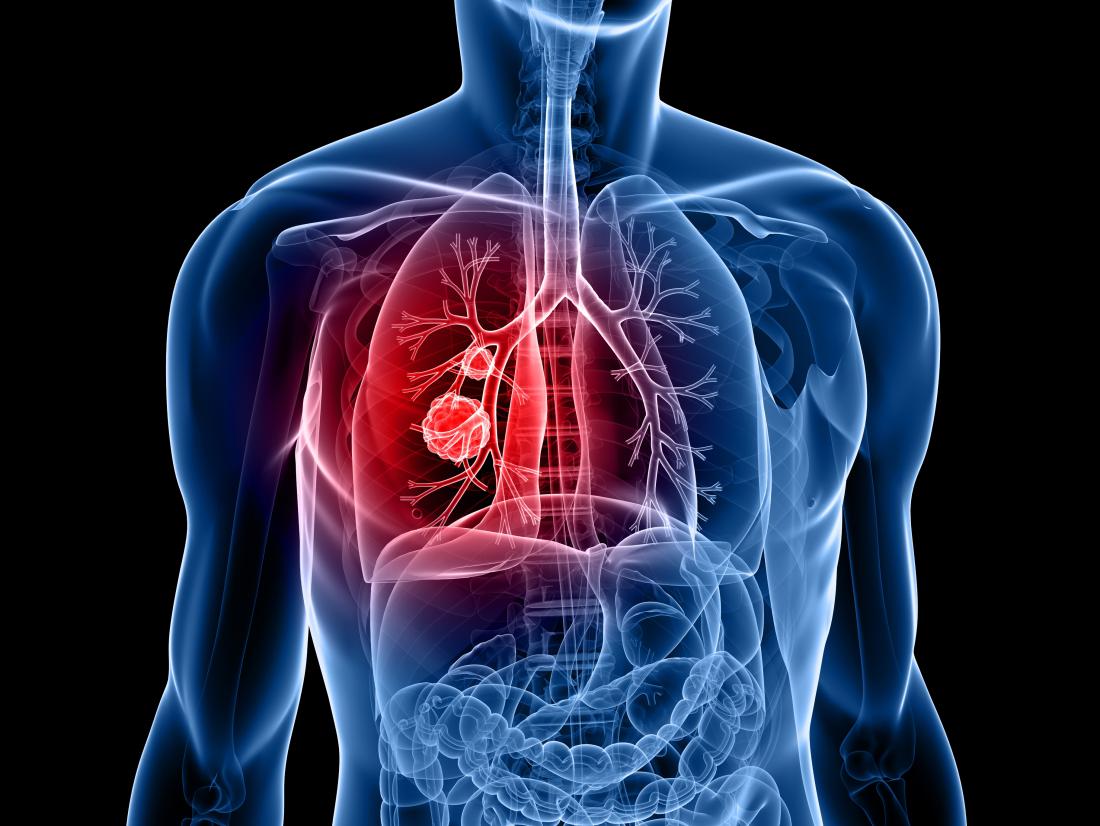 Facts About Lung Cancer