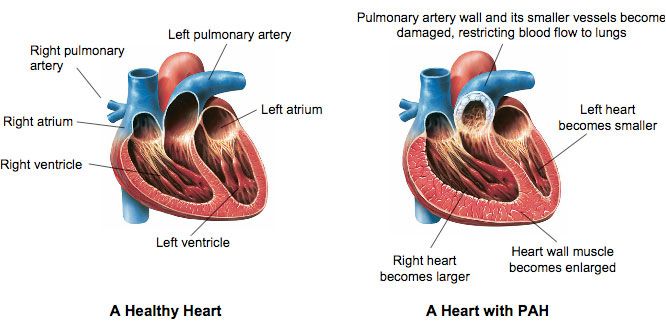 Pulmonary Arterial Hypertension(PAH)