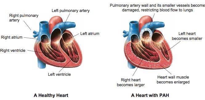 https://api.parashospitals.com/uploads/2020/10/Pulmonary-Arterial-HypertensionPAH.jpg