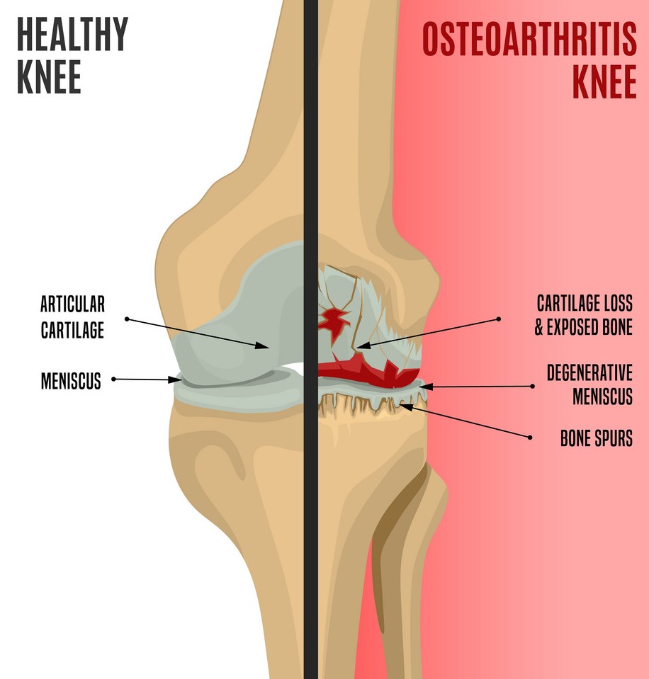 Osteoarthritis Knee 6061