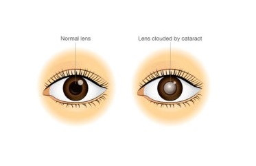 Cataract a preventable cause of blindness