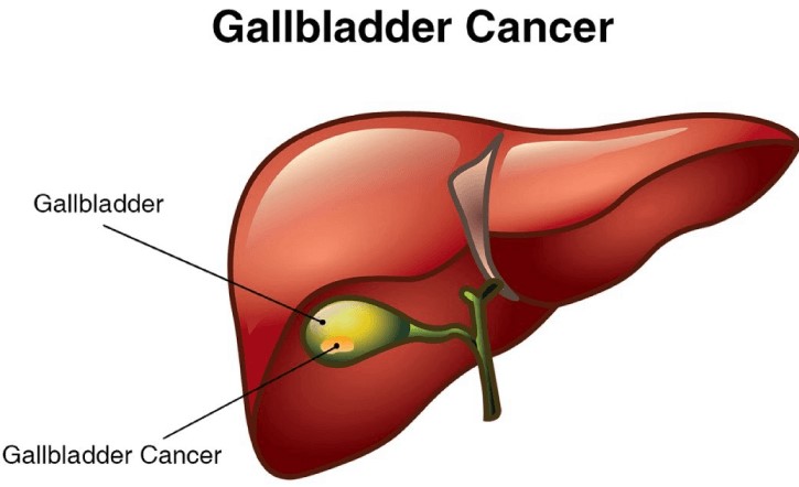 Why is Gallbladder cancer so common in India?