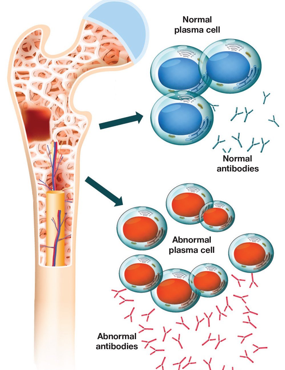 multiple myeloma