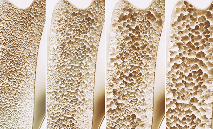 Osteoporosis – The Silent Bone Killer