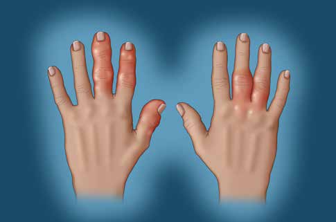 Multiple Joint Pain And Rheumatoid Arthritis