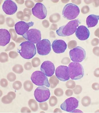 What is Acute Leukemia?